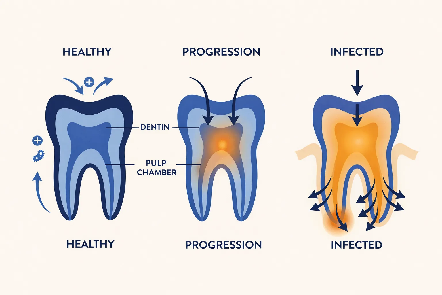 Can a Tooth Infection Spread to the Body? - Tooth infection abscess.jpg