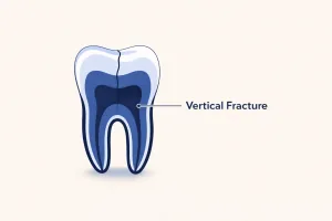 Diagram showing different types of cracked tooth fractures and their symptoms