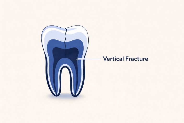 Cracked Tooth Symptoms: What to Watch For