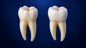 3D illustration showing a cracked tooth and the same tooth restored with a protective dental crown