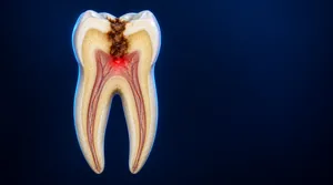 3D cross-section illustration showing how tooth decay progresses from the enamel toward the inner nerve