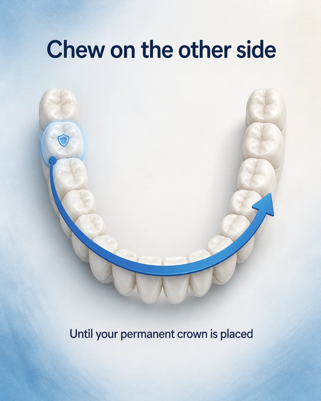 Lower dental arch seen from above with the treated tooth highlighted in blue and an arrow showing chewing on the opposite side