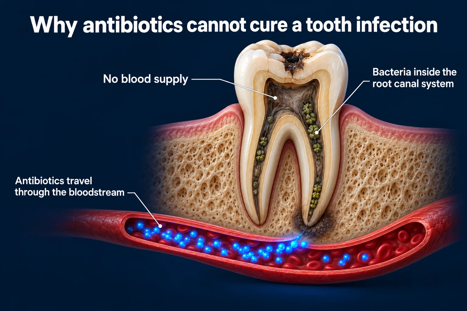A molar cut in half in the jawbone on a dark blue background. Its dead grey-brown pulp holds green clusters of bacteria. Below the roots, a red blood vessel carries glowing blue dots that stop at the root tip. Labels read No blood supply, Bacteria inside the root canal system, and Antibiotics travel through the bloodstream.