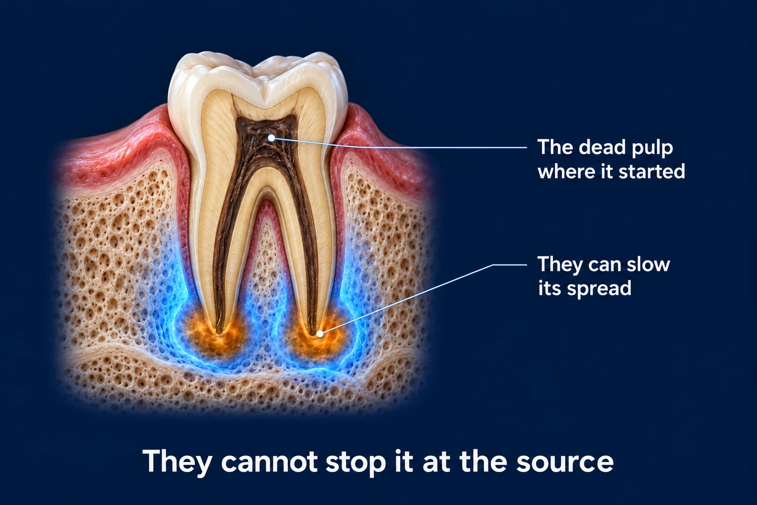 A molar cut in half in bone on a dark blue background. The pulp inside is dark brown, and small orange glows at the root tips are ringed by a cool blue glow that holds them back. Labels read The dead pulp where it started and They can slow its spread, with the caption They cannot stop it at the source.