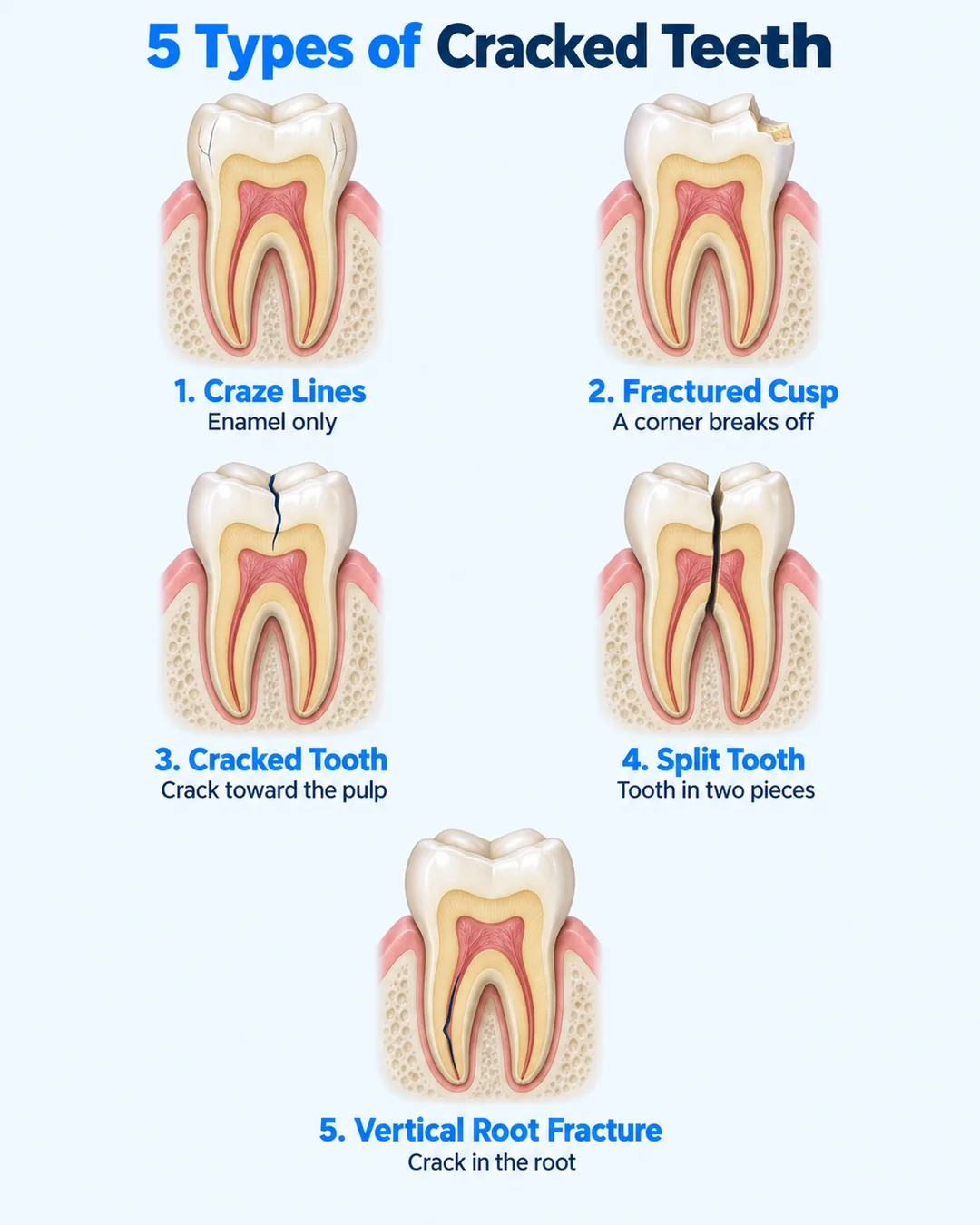 What Happens If You Crack a Tooth? - Cracked tooth five types