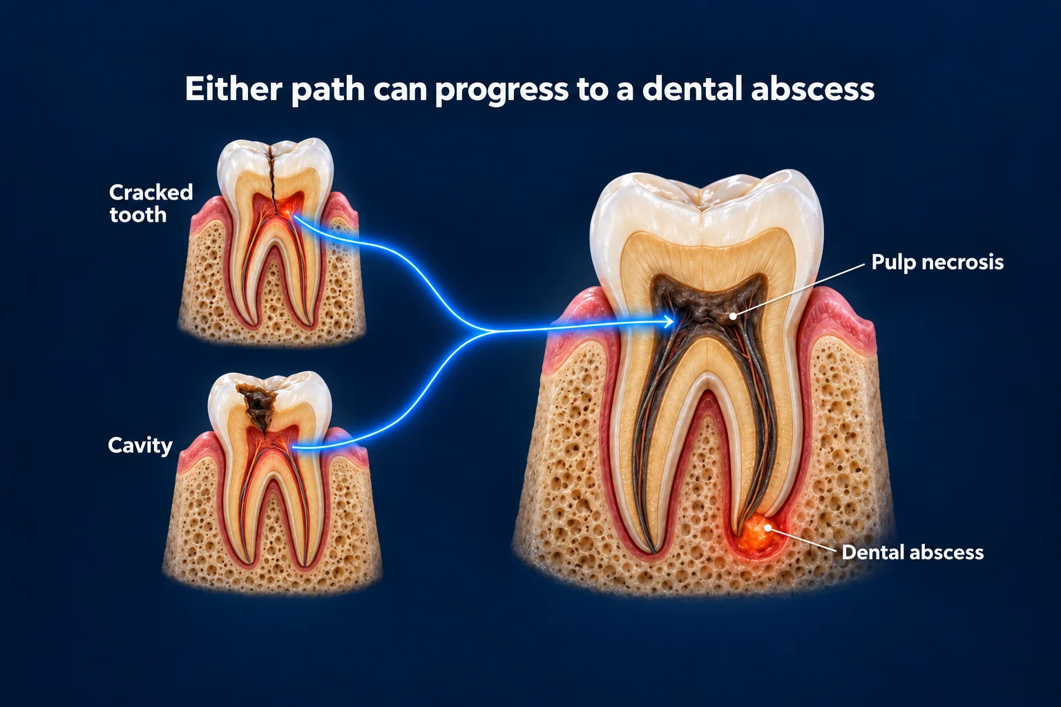 Three molars cut in half on a dark blue background under the title Either path can progress to a dental abscess. A small cracked tooth and a small tooth with a cavity each send a glowing line into one larger tooth with a dark, dead pulp and a small glowing spot at its root tip, labeled Pulp necrosis and Dental abscess.