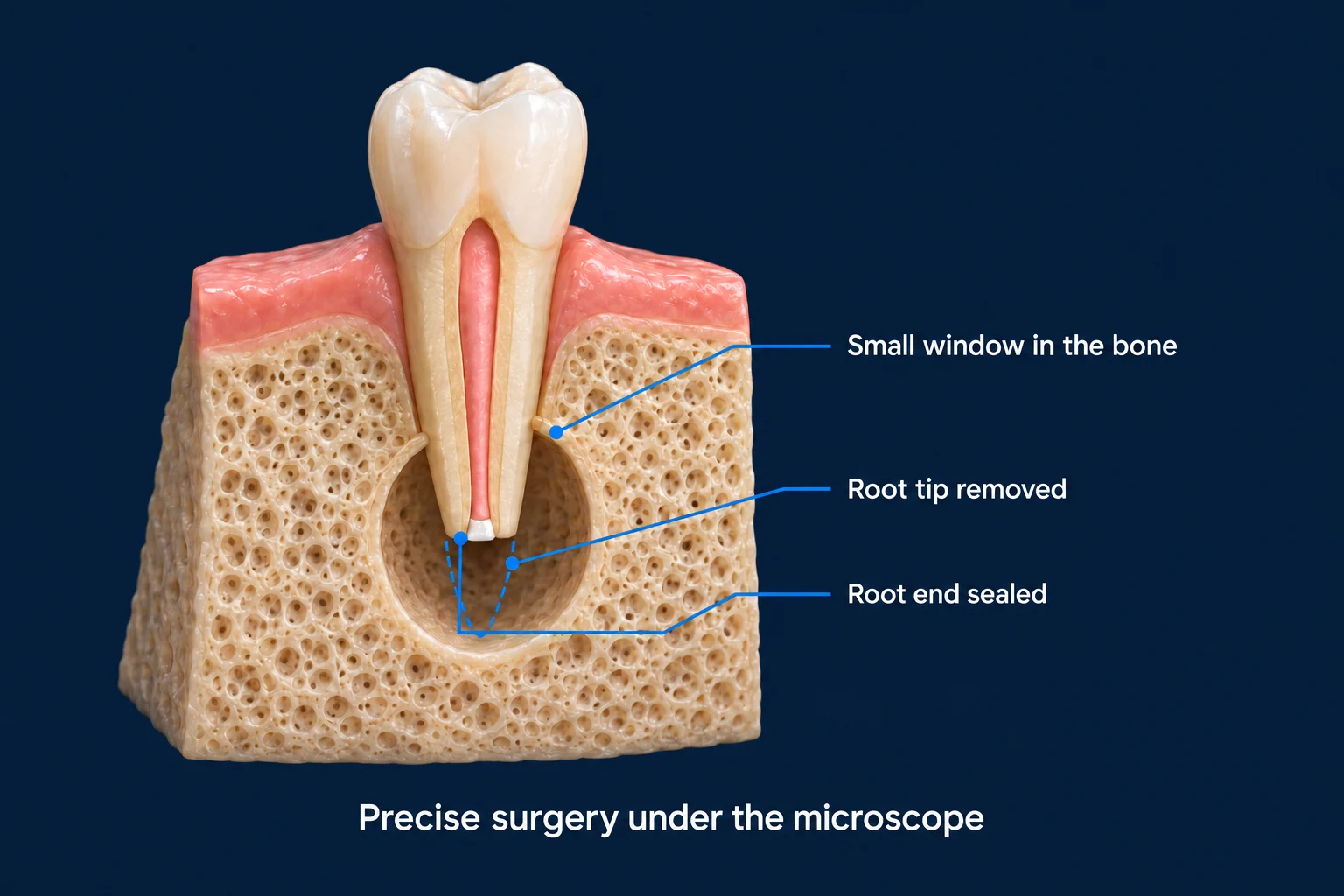 A premolar standing in a block of gum and bone on a dark blue background, crown up. A round window is opened in the bone around the lower root. The root ends in a flat cut with a small white seal, and a dashed outline below shows where the tip was removed. Labels read Small window in the bone, Root tip removed, and Root end sealed, with the caption Precise surgery under the microscope.