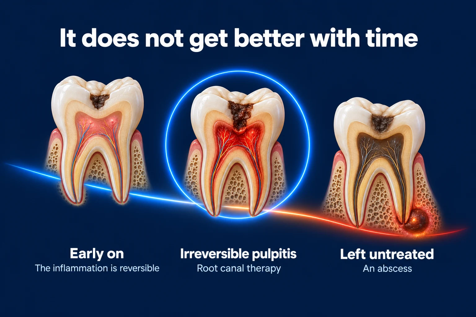 Three molars cut in half on a dark blue background under the title It does not get better with time. The first has a small cavity and pink pulp, the middle one has deeper decay and red pulp, and the last has a dark pulp with a glowing spot at the root tip. Labels read Early on, Irreversible pulpitis, and Left untreated.