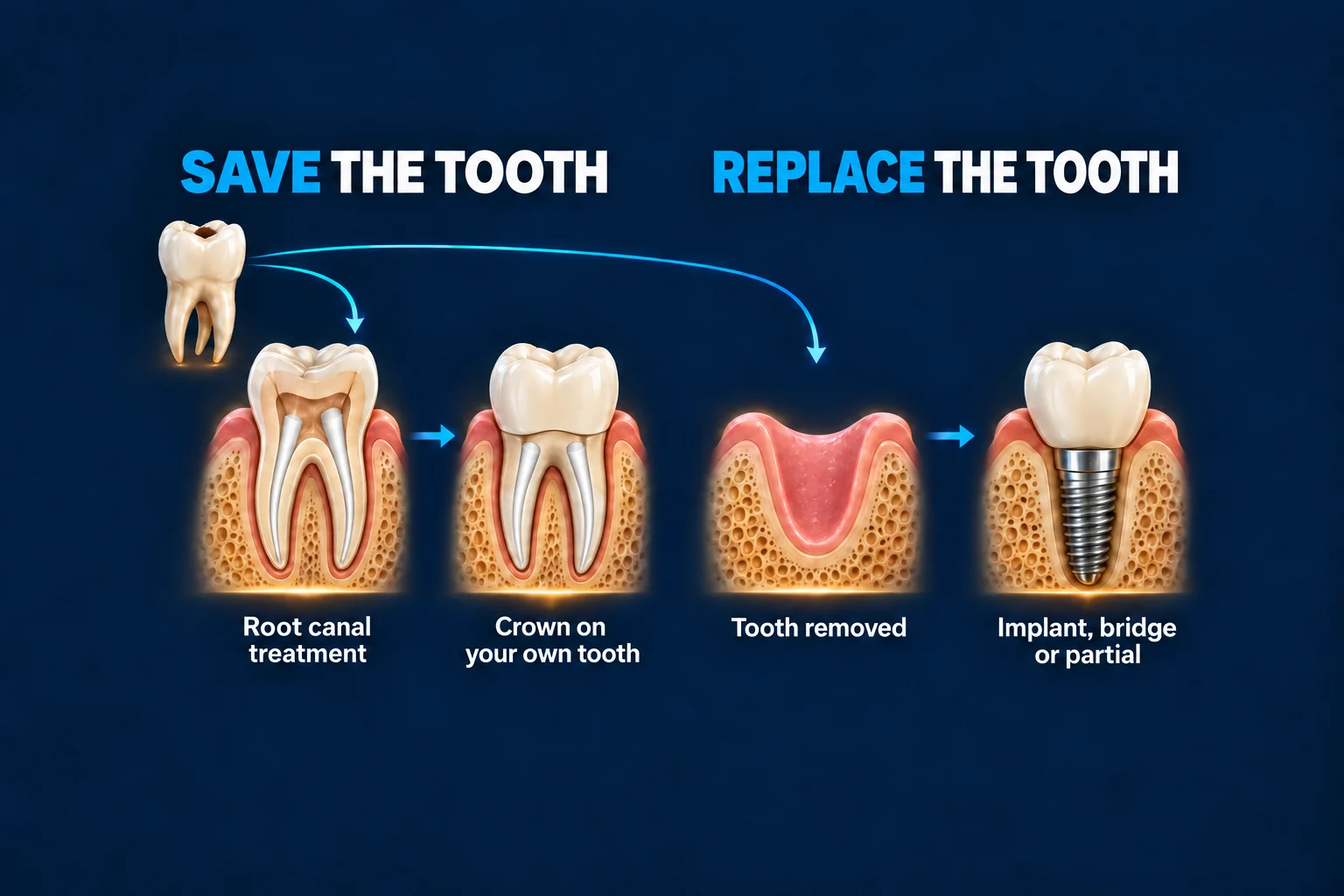 Two paths for a damaged tooth. Save it with a root canal and a crown. Or have it removed and replaced with an implant, bridge or partial.