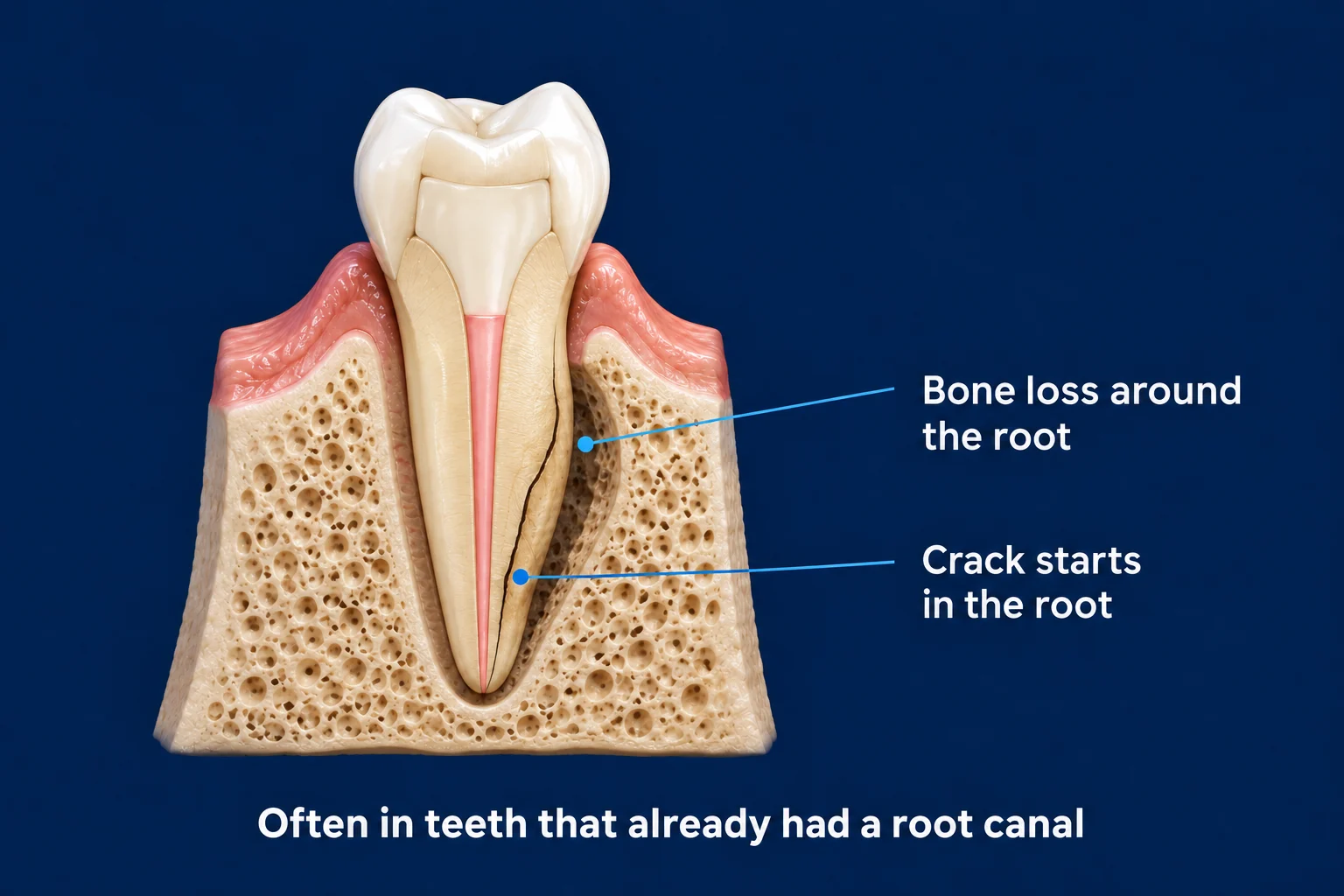 A premolar in gum and bone on a dark blue background, cut open to show a pink root filling and a tooth-colored filling above it. A thin dark crack runs up along the root, and the bone beside it has worn away into a dark gap. Labels read Bone loss around the root and Crack starts in the root, with the caption Often in teeth that already had a root canal.