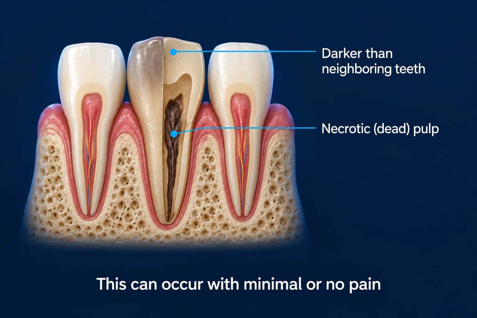 Three lower front teeth in gum and bone on a dark blue background. The middle tooth is a dull gray-brown and is cut open to show a dark, shriveled pulp, while the teeth on each side are pale with pink pulp inside. Labels read Darker than neighboring teeth and Necrotic (dead) pulp, with the caption This can occur with minimal or no pain.