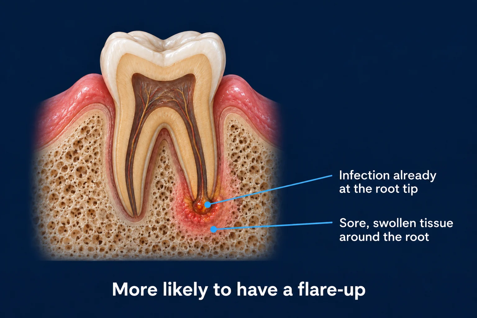 A molar cut in half in gum and bone on a dark blue background. The pulp inside is dark brown, and a small orange-red spot sits at the tip of one root inside a pink, swollen area. Labels read Infection already at the root tip and Sore, swollen tissue around the root, with the caption More likely to have a flare-up.