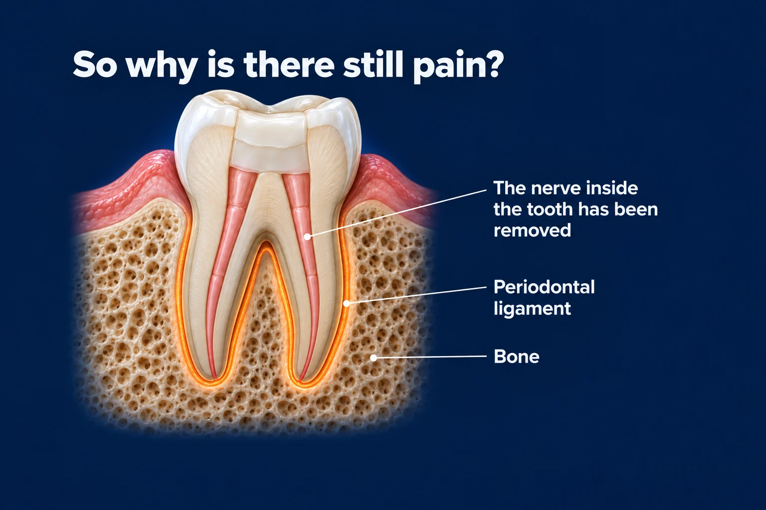 A treated molar cut in half in the jawbone on a dark blue background, its canals filled and sealed. A thin orange glow wraps around the roots. Labels read The nerve inside the tooth has been removed, Periodontal ligament, and Bone, under the title 'So why is there still pain?'.