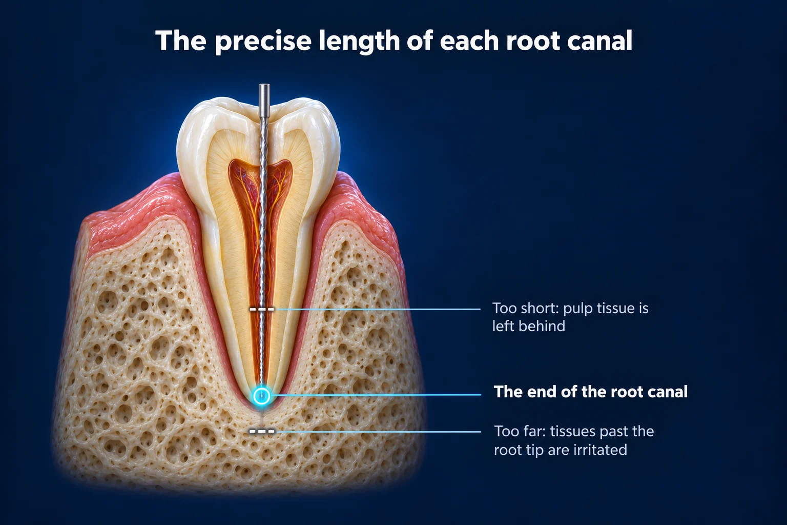 A tooth cut in half and set in bone on a dark blue background under the title The precise length of each root canal. A thin metal file runs down the canal and stops at a glowing ring at the root tip, labeled The end of the root canal. A mark higher up reads Too short: pulp tissue is left behind, and a mark below the tip reads Too far: tissues past the root tip are irritated.