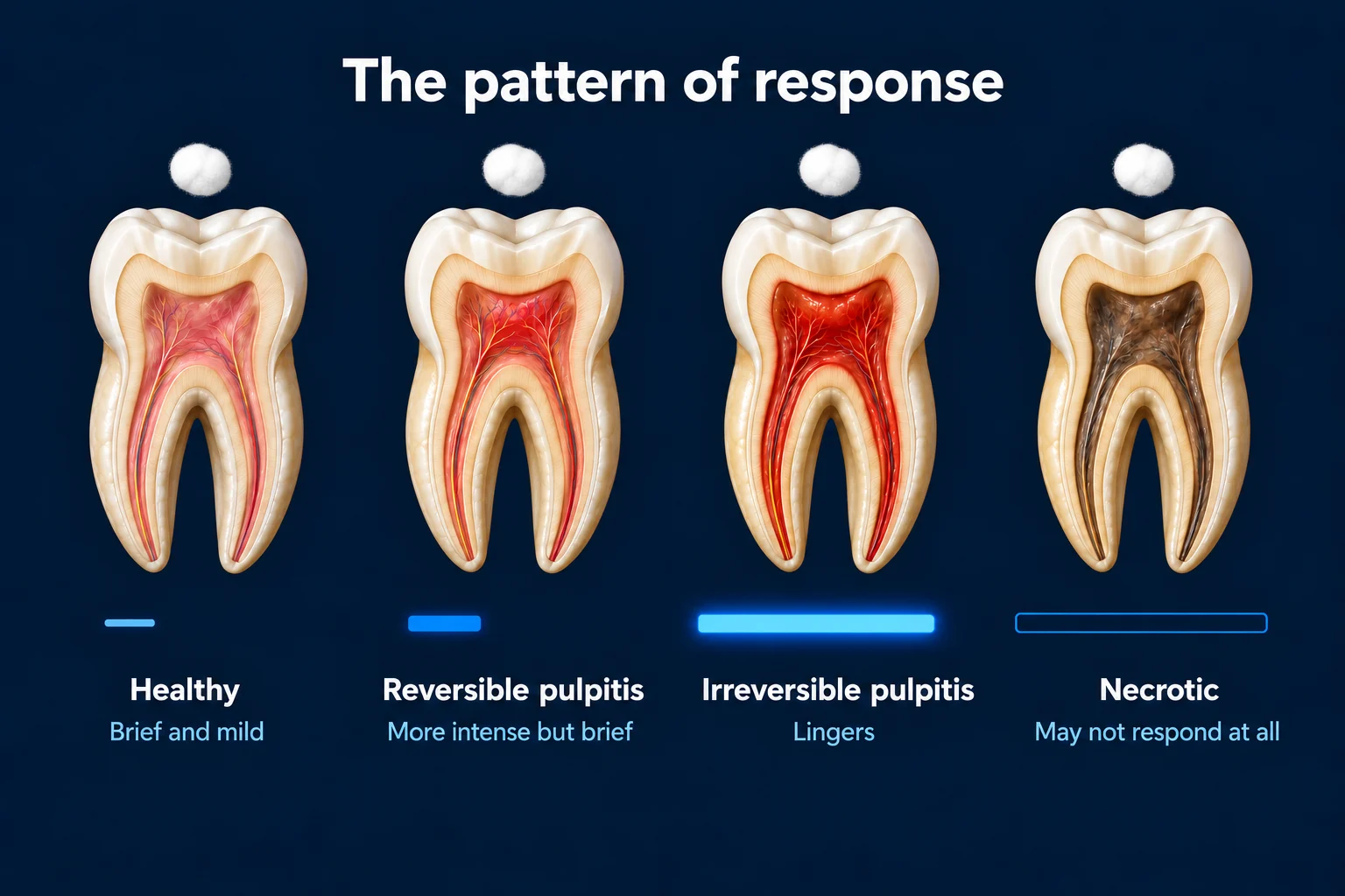 Four molars cut in half on a dark blue background, each with a cotton pellet above it, under the title 'The pattern of response'. A blue bar under each shows the reaction: Healthy, brief and mild; Reversible pulpitis, more intense but brief; Irreversible pulpitis, lingers (the longest bar); Necrotic, may not respond at all (an empty bar).