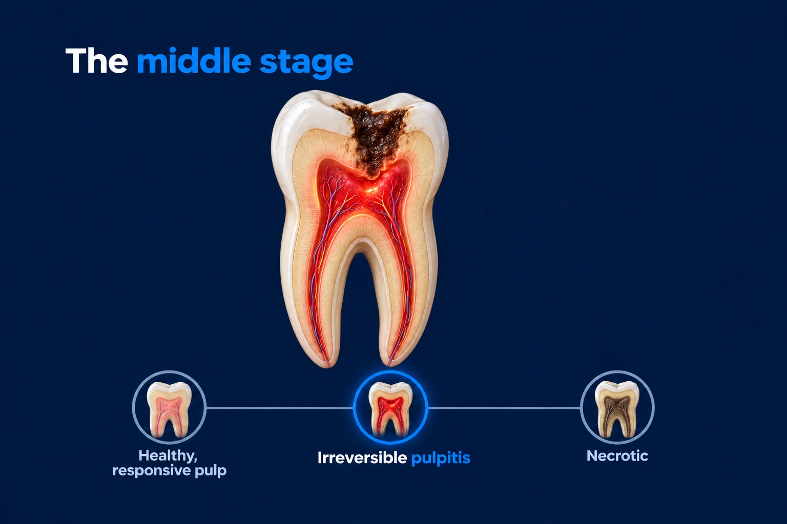 A molar cut in half on a dark blue background, with dark decay in the top reaching a swollen red pulp. Below it, three small tooth icons on a line read Healthy, responsive pulp; Irreversible pulpitis (lit up in blue); and Necrotic. The title reads 'The middle stage'.