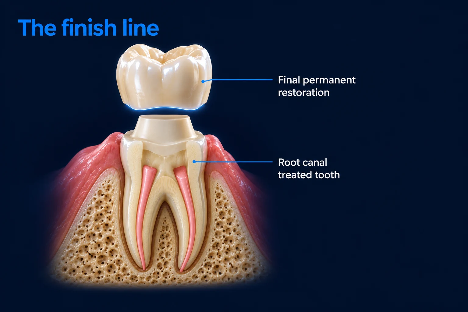 A treated molar cut in half in the gum and jawbone on a dark blue background, with a tooth-colored crown floating just above it, ready to fit. Labels read Final permanent restoration and Root canal treated tooth, under the title 'The finish line'.