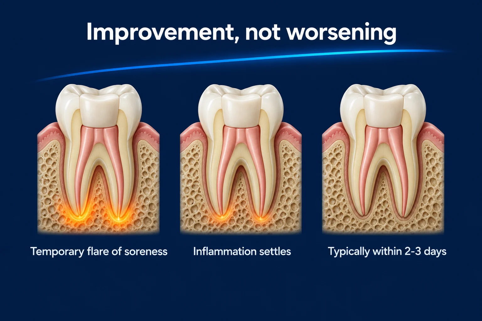 Three treated molars cut in half in the jawbone on a dark blue background, under the title 'Improvement, not worsening'. An orange glow at the root tips is bright on the first tooth, faint on the second and gone on the third. Labels read Temporary flare of soreness, Inflammation settles, and Typically within 2-3 days.