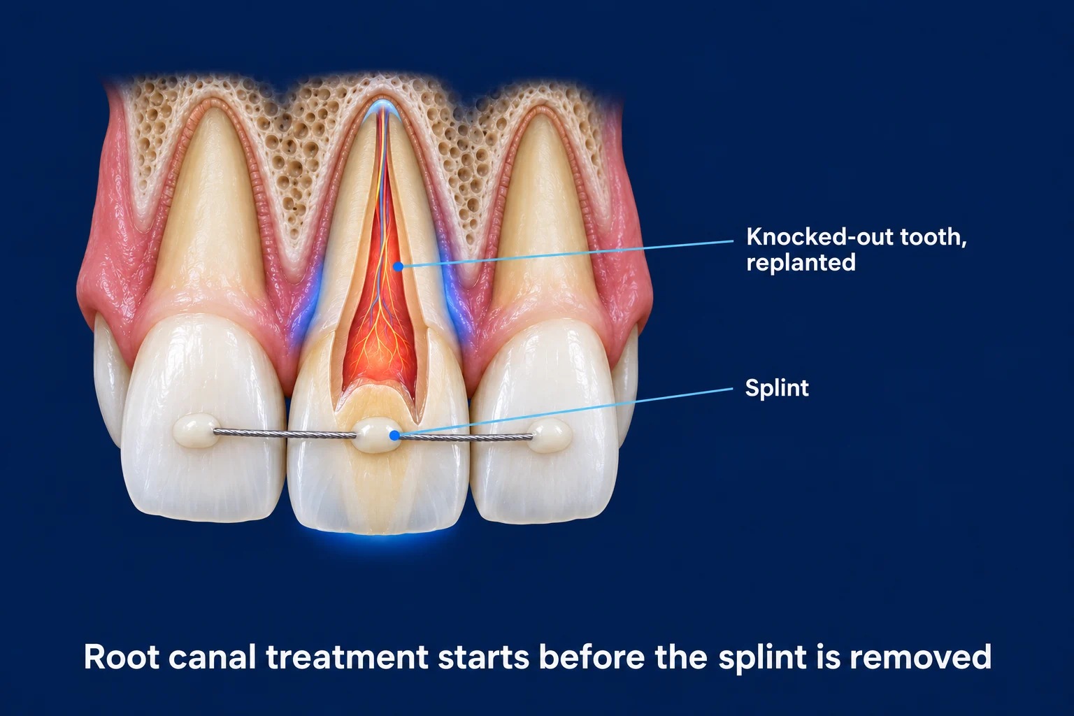 Three upper front teeth in gum and bone on a dark blue background, joined by a thin wire bonded across their fronts. The middle tooth is cut open to show a reddish pulp and has a soft blue glow. Labels read Knocked-out tooth, replanted and Splint, with the caption Root canal treatment starts before the splint is removed.